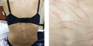 Gegara Makan Jamur Shiitake, Wanita Ini Alami Ruam Aneh Mirip Bekas Cambukan di Punggung
